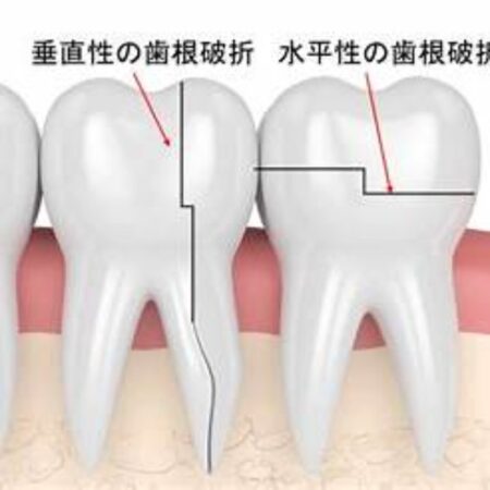 歯根破折――骨折との違いと治療の選択肢