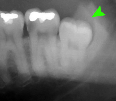 親知らず、そのままで大丈夫?抜歯の基準と当院の対応について