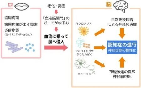 歯周病と認知症の関係――いま分かっていることと、今日からできる予防