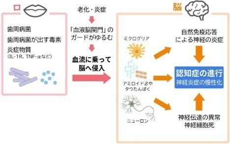 歯周病と認知症の関係――いま分かっていることと、今日からできる予防