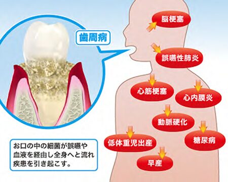 歯周病が全身の健康に及ぼす影響 —お口は体の入り口です—