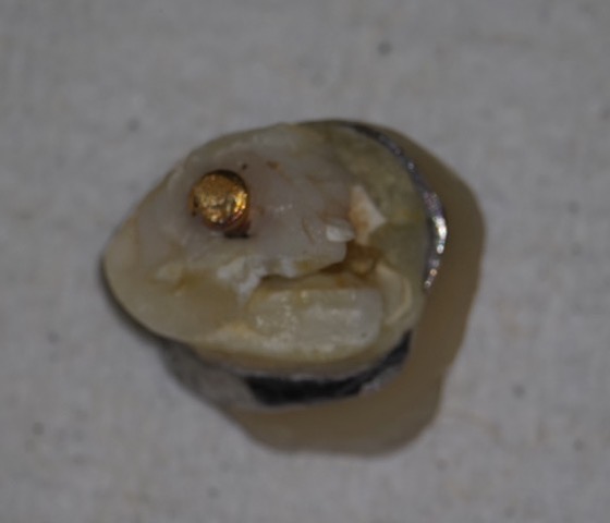 詰め物・被せ物が取れてしまったとき、やってはいけないこと