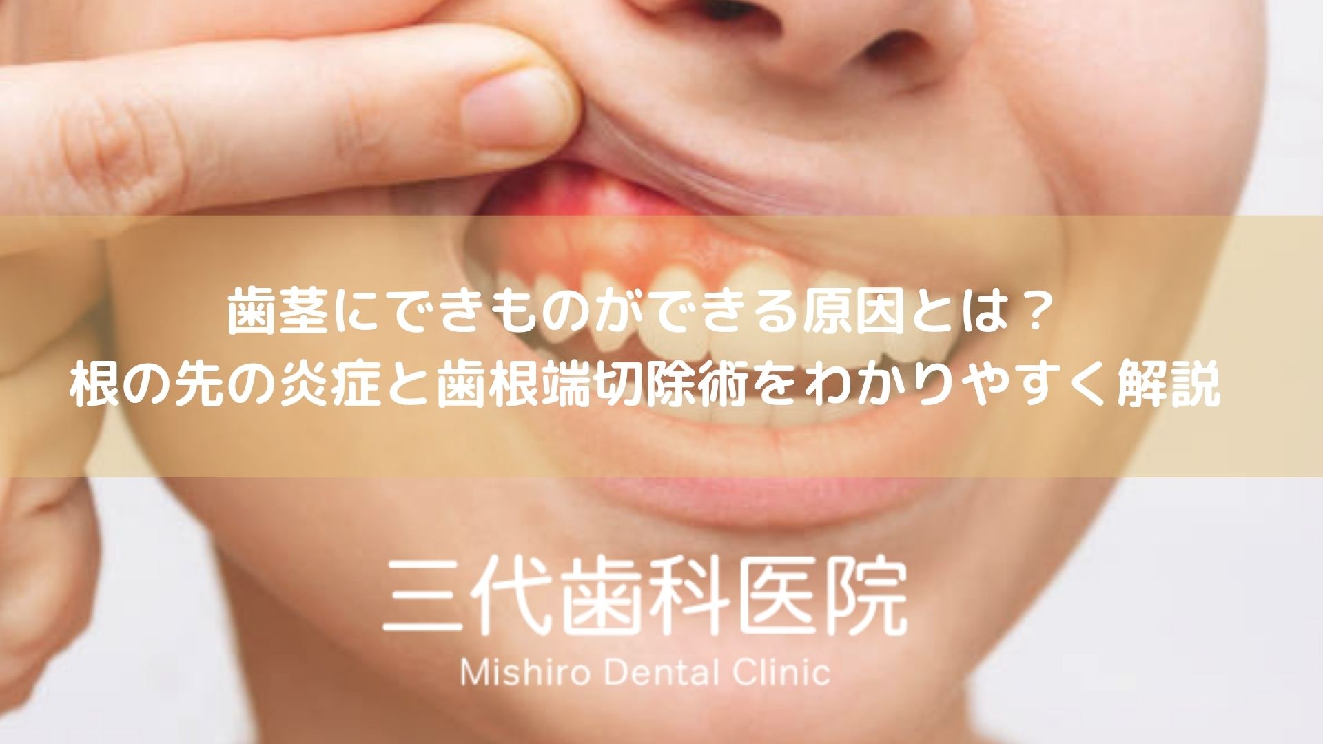 歯茎にできものができる原因とは？根の先の炎症と歯根端切除術をわかりやすく解説