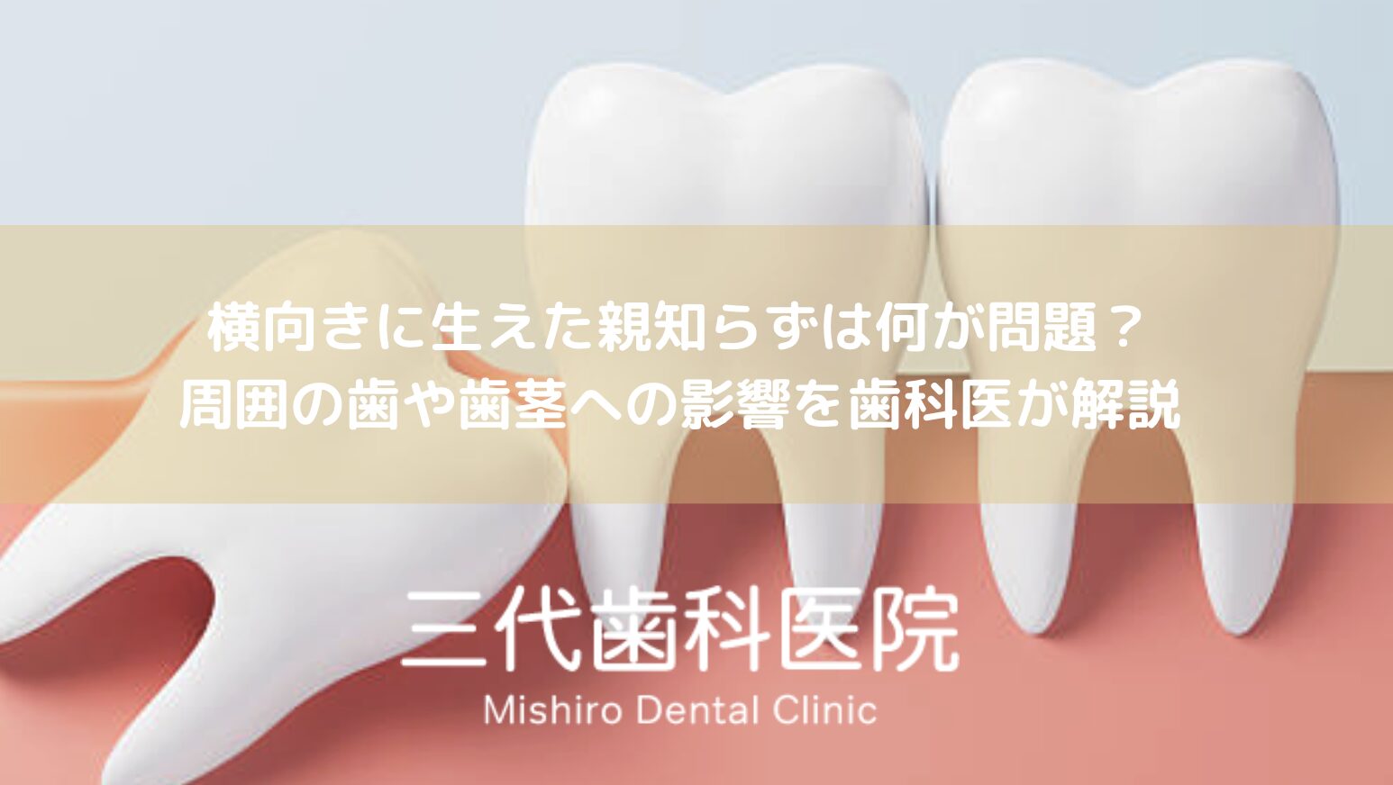 横向きに生えた親知らずは何が問題?周囲の歯や歯茎への影響を歯科医が解説