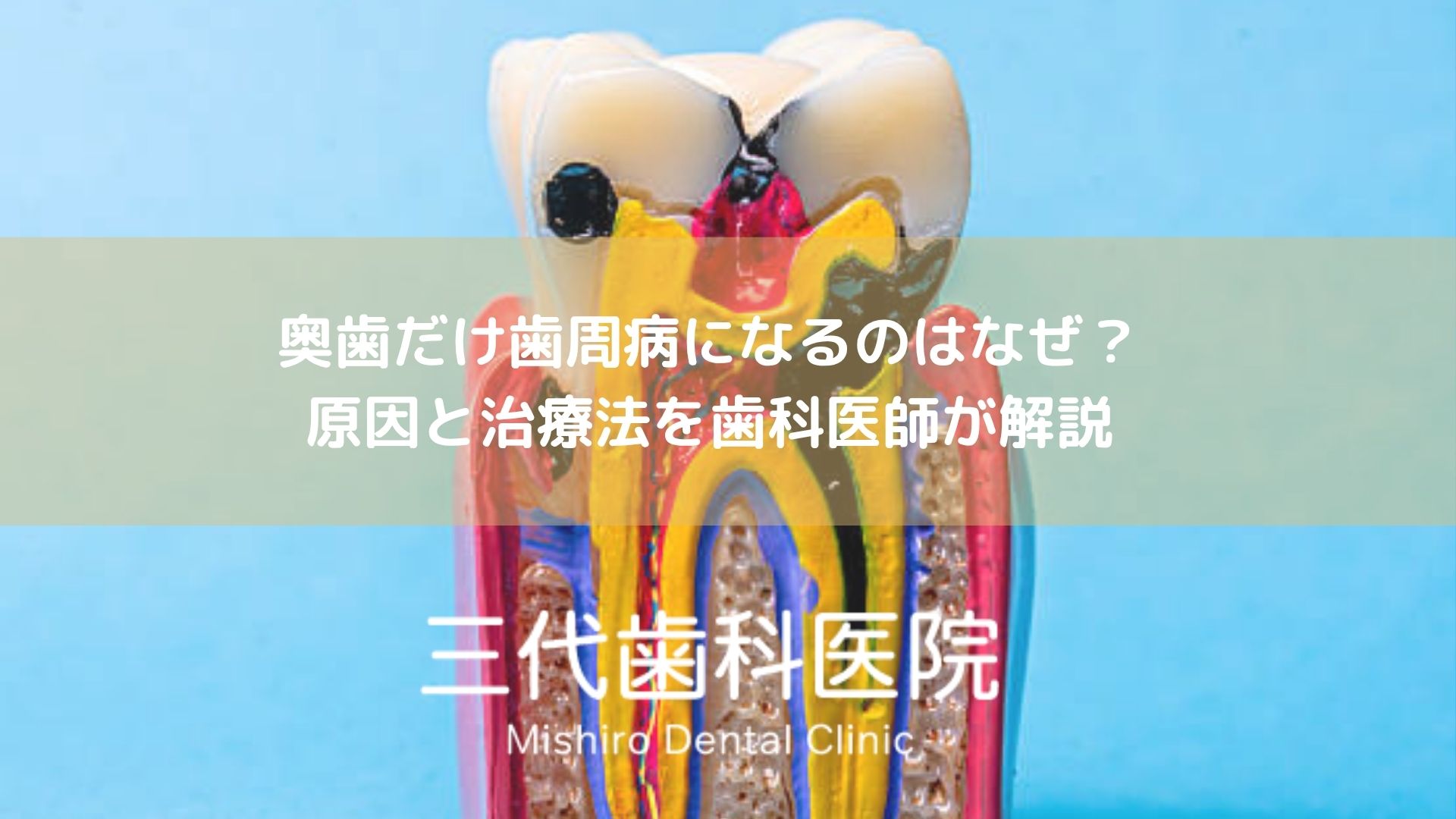 奥歯だけ歯周病になるのはなぜ？原因と治療法を歯科医師が解説