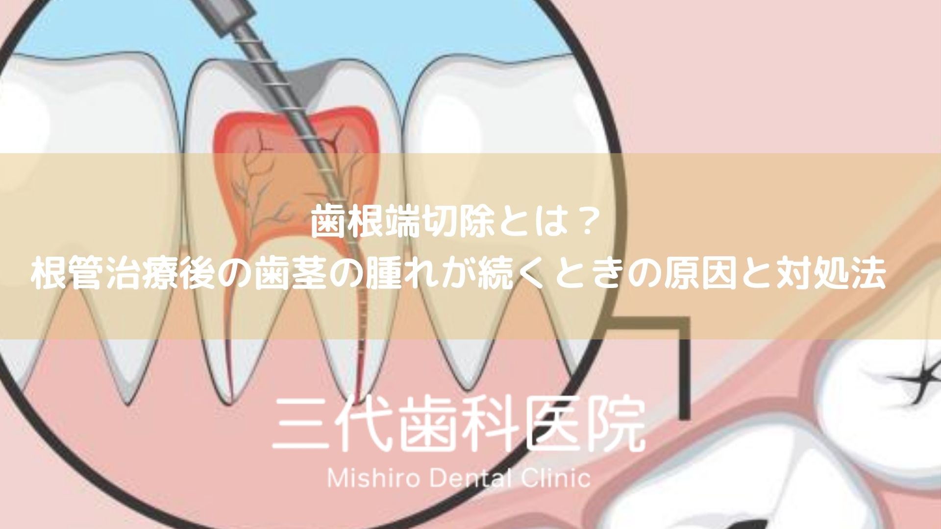 歯根端切除とは？根管治療後の歯茎の腫れが続くときの原因と対処法