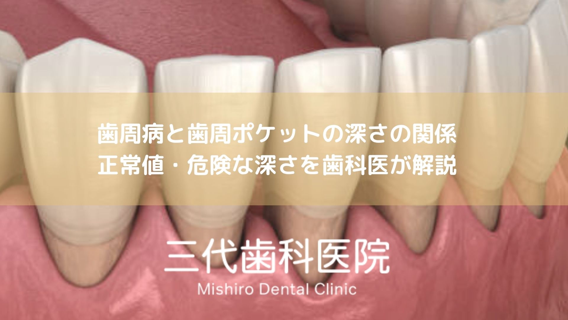 歯周病と歯周ポケットの深さの関係｜正常値・危険な深さを歯科医が解説